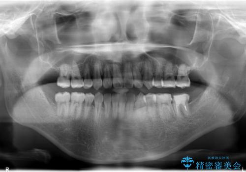 八重歯と開咬の治療の治療後