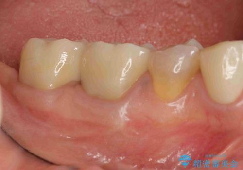 [深い虫歯]  歯周外科を用いたオールセラミック治療の治療後
