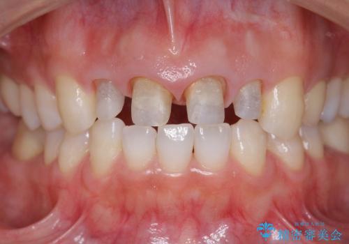 [前歯部審美治療] 仮歯からオールセラミッククラウンへの治療中