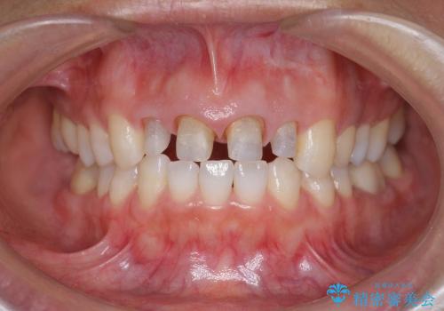 [前歯部審美治療] 仮歯からオールセラミッククラウンへの治療中