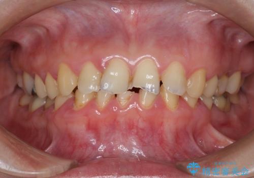 [酸蝕歯] オールセラミッククラウンを用いた全顎治療の治療前
