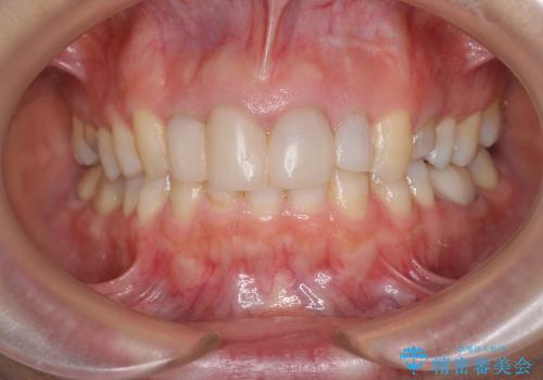 [前歯部審美治療] 仮歯からオールセラミッククラウンへの治療前