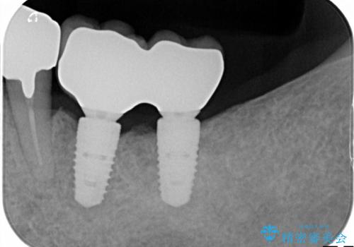 奥歯のインプラントと前歯のセラミックの治療後