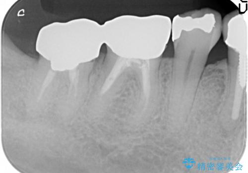 [深い虫歯]  歯周外科を用いたオールセラミック治療の治療前