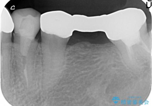 [深い虫歯]  歯の挺出処置を行ったオールセラミック治療の治療前