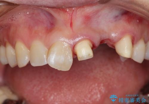 前歯がグラグラで残せない　上顎前歯ブリッジ治療の治療中