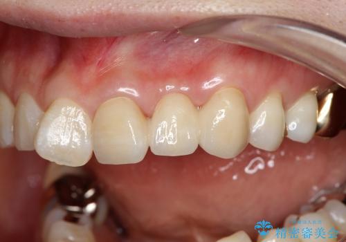 前歯がグラグラで残せない　上顎前歯ブリッジ治療の治療後