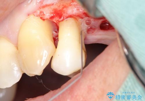 [歯周病治療①] 歯周病で溶けてしまった歯槽骨の再生手術　の治療中