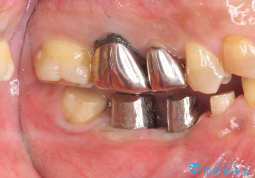 [咬合性外傷] インプラント補綴で残った歯を守る治療の治療中