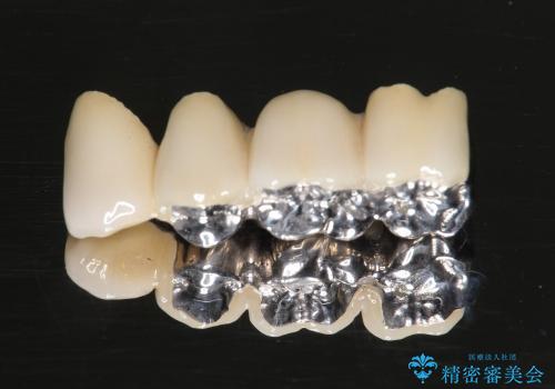 [歯周病治療③] メタルボンドブリッジ補綴で咬合機能の回復