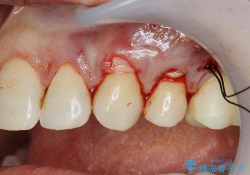 [知覚過敏]  歯ぐきが下がってしみる歯を歯肉移植で改善の治療中
