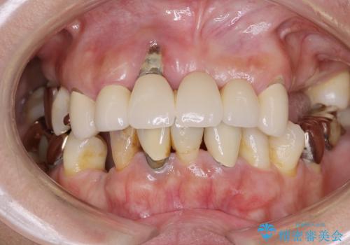 [顎堤増大]  歯肉移植を行い審美性を回復した前歯ブリッジ治療の治療前
