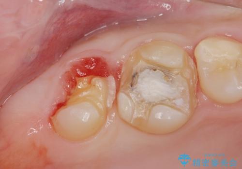 [歯周外科] 歯ぐきの状態を整えてからのセラミック治療の症例 治療前