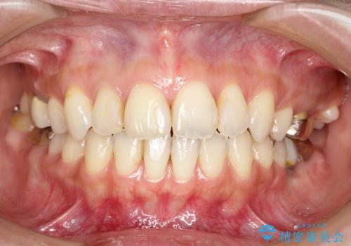 歯並びを整えたら、銀歯が気になってきた　矯正治療後の審美治療