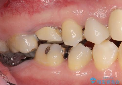 [縁下カリエス] 多発した深い虫歯の治療の症例 治療前
