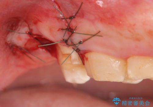 [歯周外科] 歯ぐきの状態を整えてからのセラミック治療の治療前