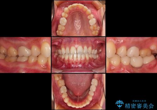 歯並びを整えたら、銀歯が気になってきた　矯正治療後の審美治療の治療後