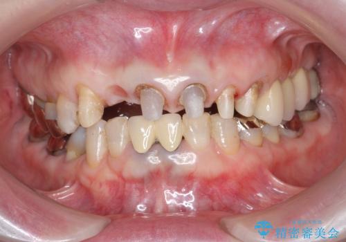[前歯部ジルコニアブリッジ] 前歯の治療で見た目を美しくの治療中
