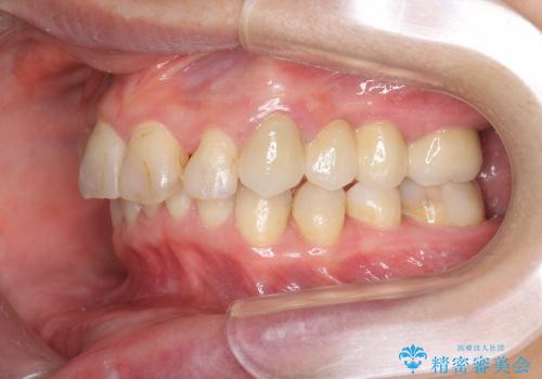 歯軸を改善したオールセラミックブリッジ治療の治療後
