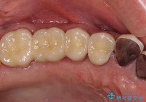 [縁下カリエス] 多発した深い虫歯の治療の治療後