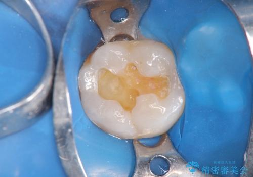 [セラミックインレー]  銀歯の下の虫歯再発 審美修復治療
