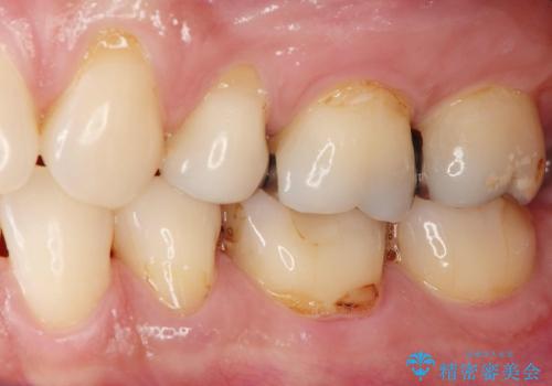 [知覚過敏]  歯ぐきが下がってしみる歯を歯肉移植で改善の治療前