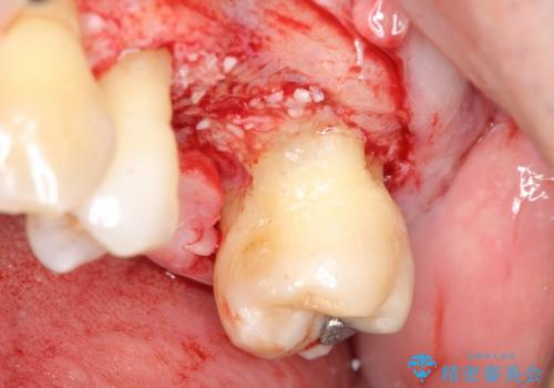 [歯周病治療①] 歯周病で溶けてしまった歯槽骨の再生手術　の治療中