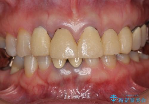 [前歯部ジルコニアブリッジ] 前歯の治療で見た目を美しくの治療前