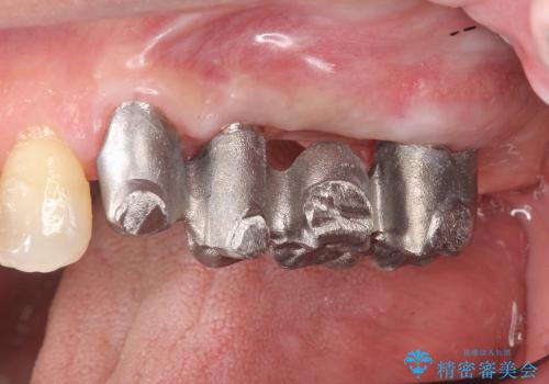 [歯周病治療③] メタルボンドブリッジ補綴で咬合機能の回復の治療中
