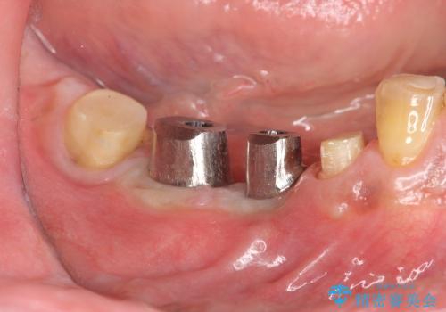 [咬合性外傷] インプラント補綴で残った歯を守る治療の治療中