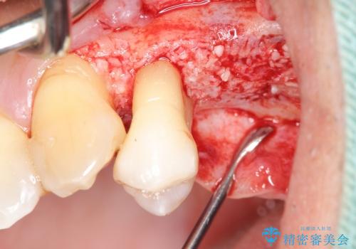 [歯周病治療①] 歯周病で溶けてしまった歯槽骨の再生手術　