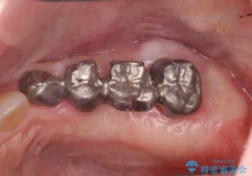[歯周病治療③] メタルボンドブリッジ補綴で咬合機能の回復の治療中