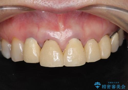 [前歯部ジルコニアブリッジ] 前歯の治療で見た目を美しくの症例 治療前