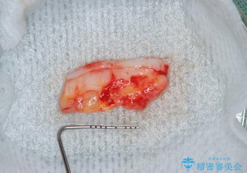 [顎堤増大]  歯肉移植を行い審美性を回復した前歯ブリッジ治療の治療中