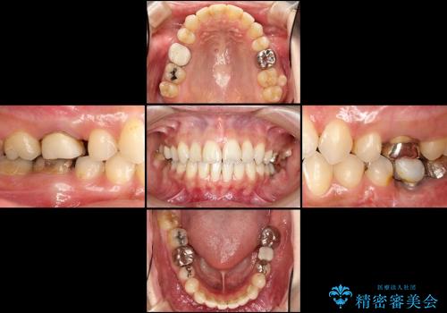 歯並びを整えたら、銀歯が気になってきた　矯正治療後の審美治療の治療前