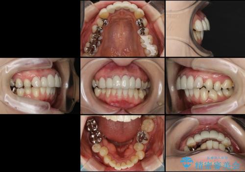 総合歯科診療　矯正希望で通院したら前歯がクラウンになっていた方の再治療の治療前