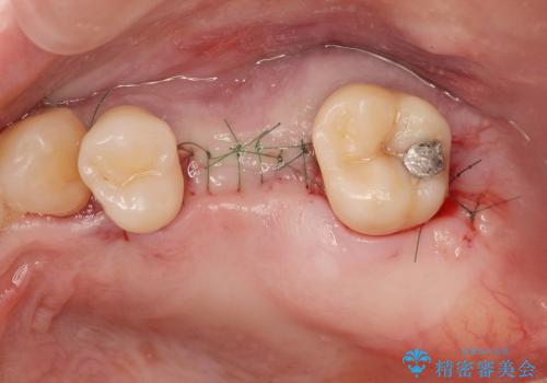 [歯周病治療①] 歯周病で溶けてしまった歯槽骨の再生手術　の治療後