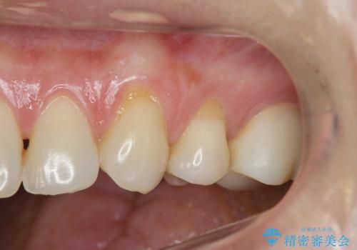 [知覚過敏]  歯ぐきが下がってしみる歯を歯肉移植で改善の治療前