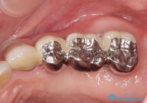 [歯周病治療③] メタルボンドブリッジ補綴で咬合機能の回復の治療後