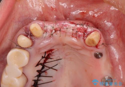 [顎堤増大]  歯肉移植を行い審美性を回復した前歯ブリッジ治療の治療中