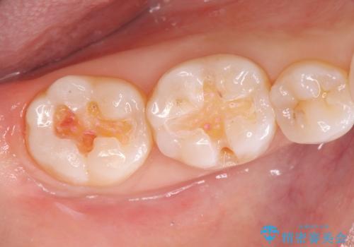 [セラミックインレー]  銀歯の下の虫歯再発 審美修復治療の治療中