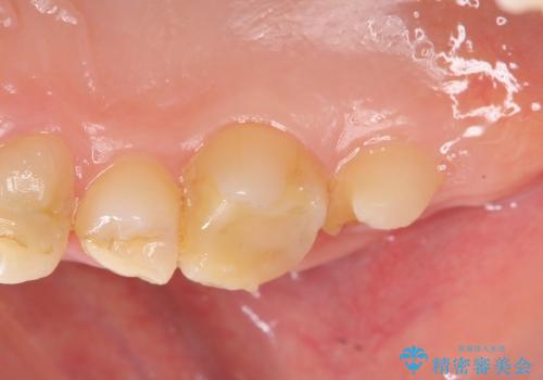 [歯周外科] 歯ぐきの状態を整えてからのセラミック治療の治療中