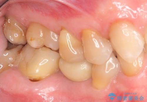 [乳歯の晩期残存]  歯周組織再生療法を併用したインプラント治療の治療後