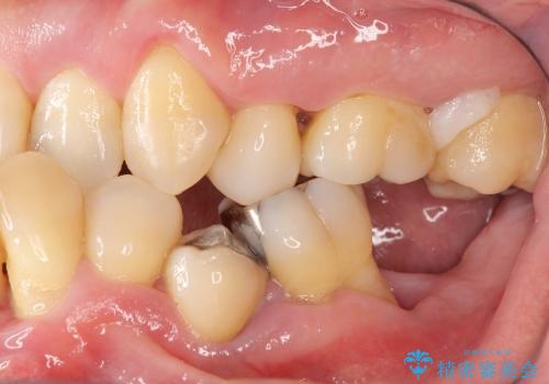 [歯周病治療③] メタルボンドブリッジ補綴で咬合機能の回復の治療前
