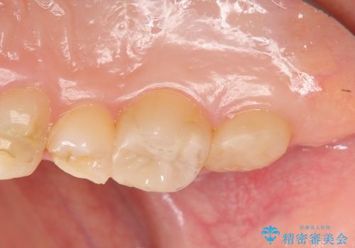 [歯周外科] 歯ぐきの状態を整えてからのセラミック治療の治療後
