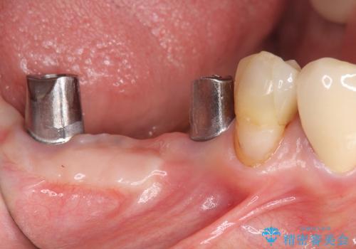 [遊離歯肉移植] インプラント周囲に強い歯ぐきを移植の治療中