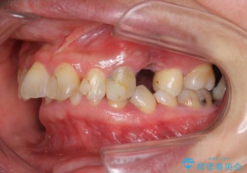 歯軸を改善したオールセラミックブリッジ治療の症例 治療前