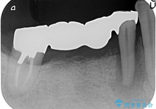 [咬合性外傷] インプラント補綴で残った歯を守る治療の治療前