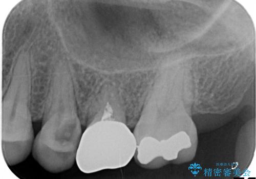 20代女性　骨レベルまで深い虫歯を保存するにはの治療前