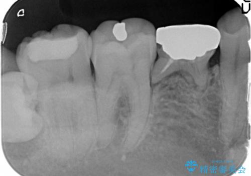 [乳歯の晩期残存]  歯周組織再生療法を併用したインプラント治療の治療前